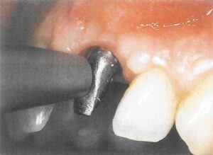 Abbildung 7. Zur Gewährleistung der Osseointegration durchgeführte Periotestmessungen.